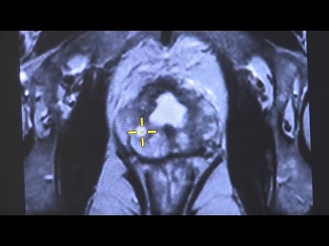 Prostate Cancer: Fusion Prostate Biopsy.