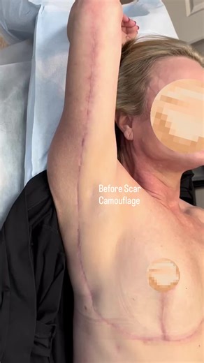 Effective Scar Camouflage Techniques after Skin Tightening
