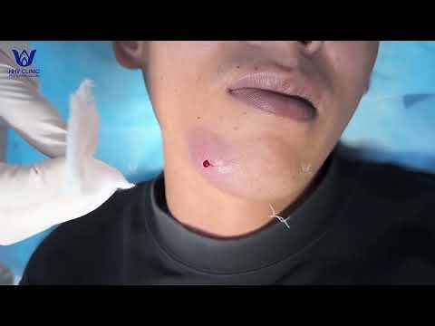 Popping severe inflammatory acne on the chin, gives you goosebumps watching it.