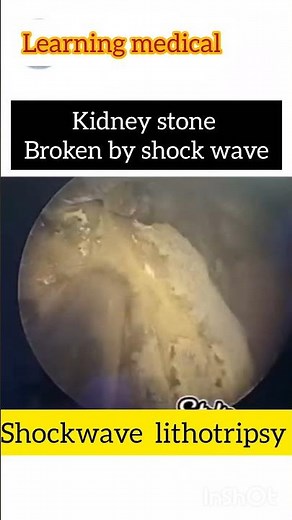 Percutaneous Nephrolithotomy (PCNL) | stone removal from kidney| PCNL | ureteroscopy