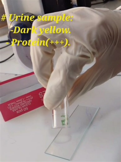 Understanding Granular Cast and Spermatozoa in Urine