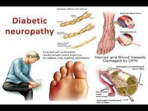 Diabetes Neuropathy: Symptoms, Causes, and Management