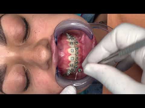🔥Mantenimiento de los Brackets Metálicos de Ortodoncia🔥