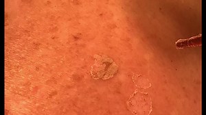 Treatment of Seborrheic Keratosis