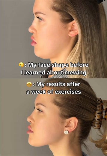 Effective Mewing Exercises to Reduce Double Chin