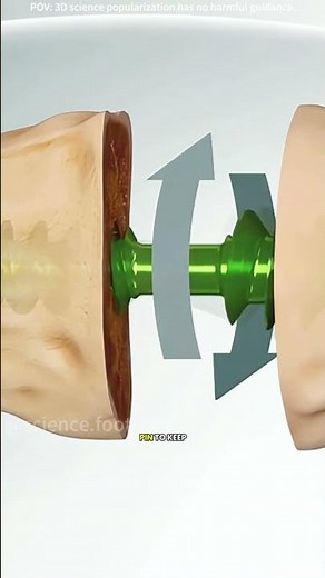 How hammer toe surgery is performed (3D animation) #footsurgery #anklefusion #tibial #footankle