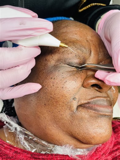 Skin Tag Removal near the Eyes in Mpumalanga