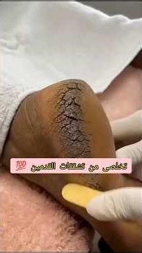 Permanent treatment for cracked heels