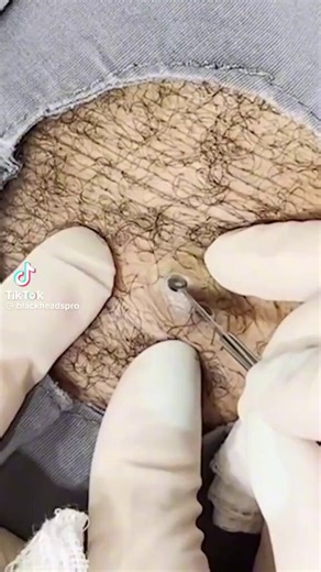 Extremely huge Blackhead extraction so satisfying it should be illegal 😭🤣Watch the pore transform in real time. If this doesn’t relax you, nothing will.#SatisfyingASMR premium satisfaction ✨