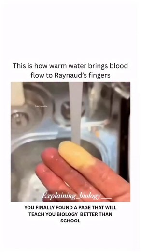Explaining Biology on Instagram: "Raynaud’s syndrome causes spasms in small blood vessels in your fingers and toes. This limits blood flow and leads to symptoms like skin color changes, cold skin and a pins and needles sensation. Common triggers of Raynaud’s attacks include cold weather and stress. Many people have mild symptoms that they can manage through lifestyle changes. To prevent Raynaud’s episodes or ease symptoms Run warm water over your hands or feet to increase blood flow. Use another