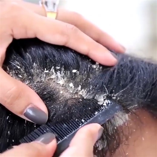 6.2K views · 44 reactions | Dandruff Scratching ASMR on Reels | Facebook