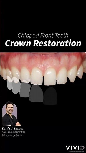 Dental Crowns for Chipped & Gapped Teeth without Braces