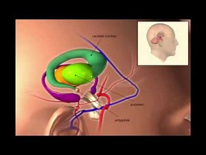 Dystonic Tremor Explained via Digital Storytelling