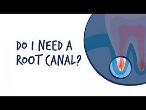 Do I Need a Root Canal?