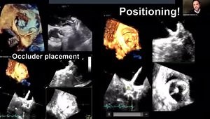 TEE Guidance for LAA Closure: Optimising TSP, 3D Sizing, Sheath Positioning and Position Post Implantation