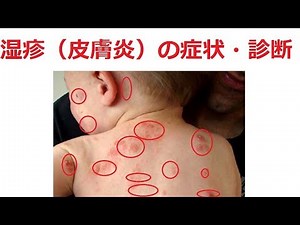 湿疹（皮膚炎）の症状・診断