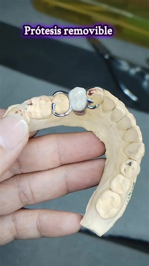 Prótesis Removible: Solución para Dientes Faltantes