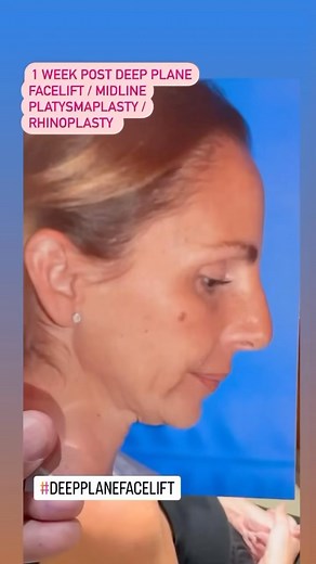 Dr Sam Rizk on Instagram: "52 yo patient shown only 1 week after deep plane facelift /necklift /midline platysmaplasty / rhinoplasty with minimal bruising and a nicely defined jawline . She will continue to improve as swelling dissipates especially with nose. #deepplanefacelift #deepecklift #faceliftsurgery #faceliftexpert #deepplanefacelifting #deepplanefaceliftexpert #drsamrizk #samrizkmd #faceliftnyc #faceliftnewyork #faceliftuae #faceliftnewyork #faceliftmiami #bestfaceliftsurgeon"