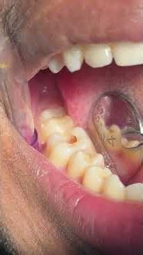 Root canal treatment / Root canal #dental #dentist