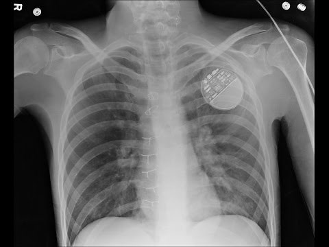 Epilepsy Neurologist Explains Vagal Nerve Stimulators (VNS)