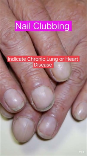 Nail Clubbing Signs for lung and heart disease