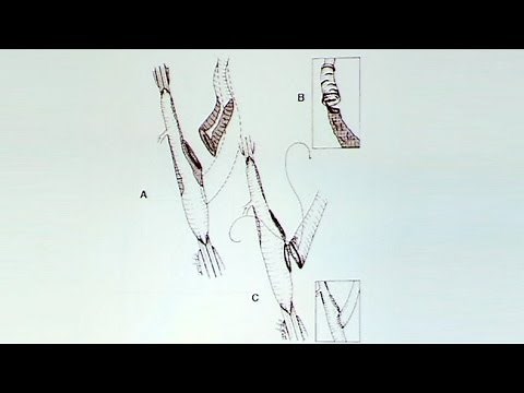 Eversion Endarterectomy: Equivalent to Standard CEA?