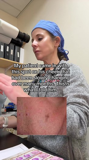 1. Brown spots that are new or changing can be benign sun spots BUT they can also be melanoma. 2. Let’s look at it closely with a magnifying glass or special polarized light called a dermatoscope. This can reveal patterns of melanoma. 3. I don’t like what I see. Let’s do a small biopsy to get a diagnosis. 4. Unfortunately the biopsy came back as melanoma. The good news is that it’s an early melanoma that’s not going very deep. We stage melanomas based on how deep they are invading in the skin. T