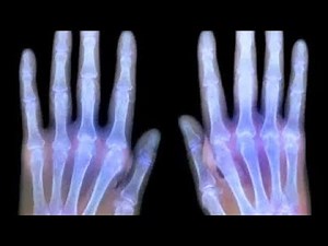 MRI Showing Cracking Of Knuckles And Joints