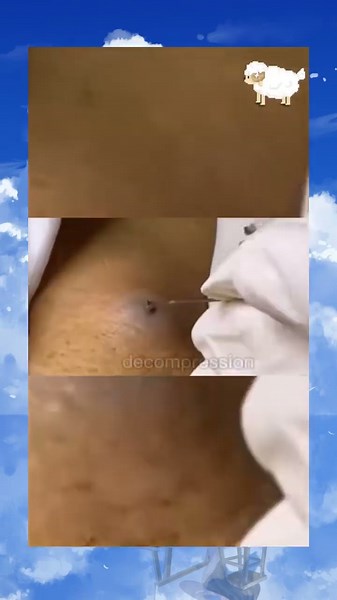 JUICY Double Cyst 😷💦 Huge pop!!