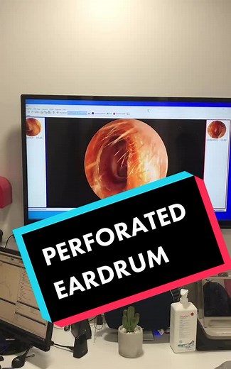 #audiology #health #medical #ears #qtip #tiktokacademie #earwax