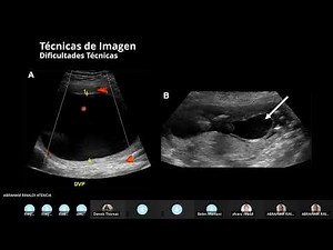 Liquido Amniotico; evaluación del volumen en Ultrasonidos