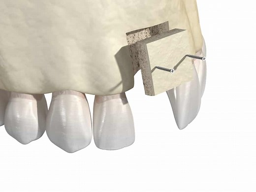 A Guide To Bone Grafts For Dental Implants