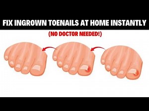 Fix Ingrown Toenails at Home Instantly (No Doctor Needed!)