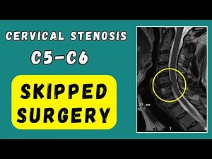 Cervical Disc Stenosis recovery without surgery C5 C6
