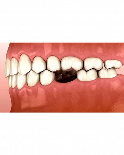 Missing a tooth? When a tooth is lost, the surrounding teeth start to...