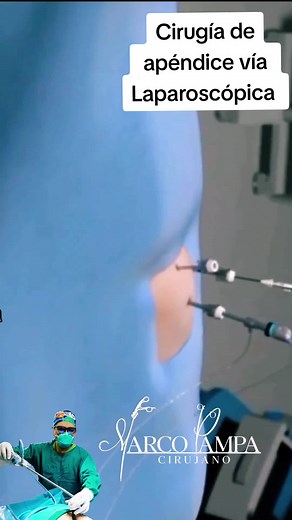Cirugía de apéndice vía Laparoscópica