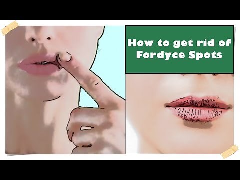 Fordyce Spots on Lips – Treatment (How to get rid of them)