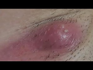 how to get rid of a boil under your arm permanently