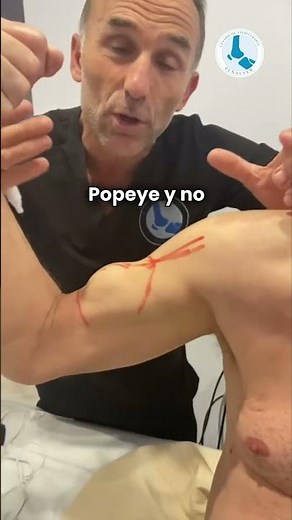 ¡El Brazo de Popeye! Rotura del Bíceps Explicada