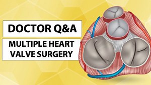 Doctor Q&A: Minimally-Invasive Multiple Heart Valve Surgery