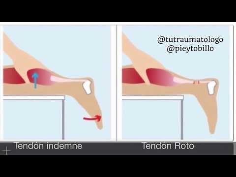 Test De Thompson para el diagnóstico de Ruptura del Tendón de Aquiles