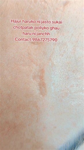 Plasma Treatment for Skin Renewal