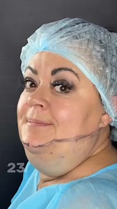 Unbelievable, almost unreal, this woman’s double chin completely disappears. Watch the full video in comments 👇👇 | Stories
