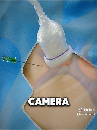 Understanding PEG Tube Insertion: A Step-by-Step Guide