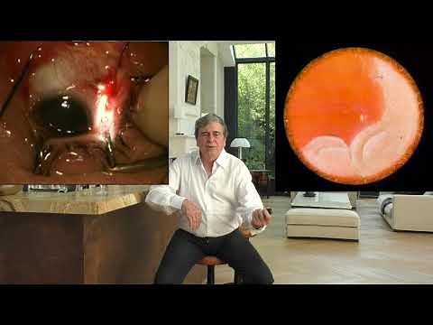 Retinal Detachment-7: Cryo and location of the tears