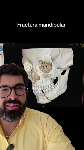 Fractura Mandibular: Accidente Automovilístico y Cuidado