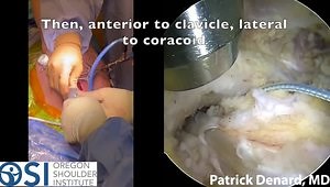 AC Joint Reconstruction: Combined AC and CC Fixation