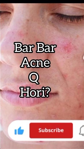 Pimple Removal On Face at Home🔥 #shorts #youtubeshorts #acnetreatment #pimpleskailaj #pimplesremoval