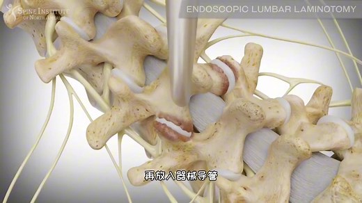 腰椎椎管狭窄的手术治疗过程，3D演示。。