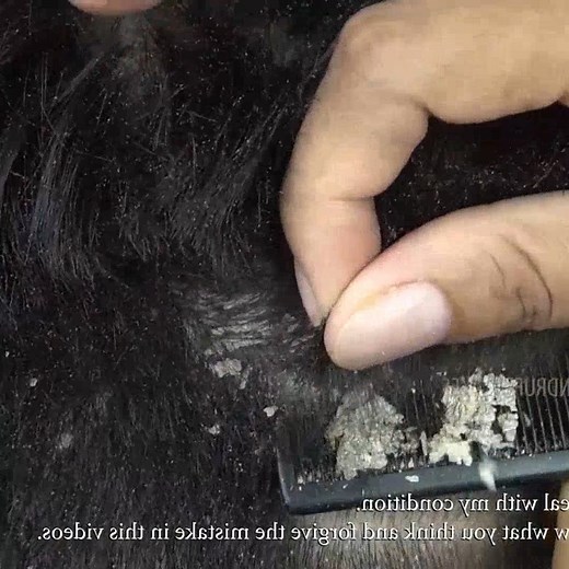 19K views · 101 reactions | WOW! Itchy Dry Scalp Big Dandruff Flakes Scratching #205 #removetick #Dandruff #dandrufftreatment #dandruffremoval #fblifestyle | Gabriela Blair | Facebook